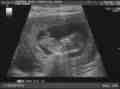[Ultrasound scan]